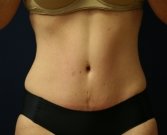Tummy Tuck San Diego 53 - after