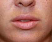 Lip Augmentation with Permalip - before