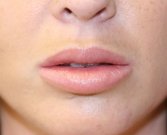 Lip Augmentation with Permalip - after