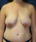 Breast Lift San Diego 24 - before