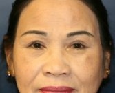 Eyelid Lift San Diego 73 - after