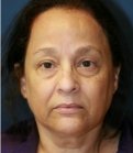 Eyelid Rejuvenation San Diego 74 - before