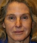 Laser Facial Skin Restoration - before