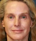 Laser Facial Skin Restoration - after