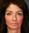 Laser Facial Skin Rejuvenation - after