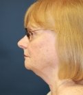 Neck Lift San Diego 24 - before