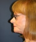 Neck Lift San Diego 24 - after