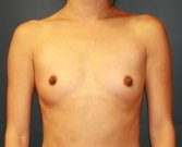Breast Augmentation Case 12 - before