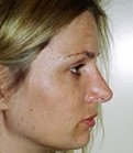 Rhinoplasty Case 10 - after