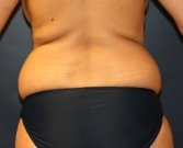 Thinner Flanks and Waist by Liposuction - before