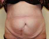 Tummy Tuck Case 15 - before