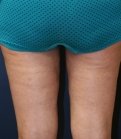 Thigh-Gap-Surgery-Liposuction - after