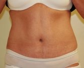 Tummy Tuck Case 15 - after