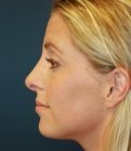 Rhinoplasty (Nose) San Diego - after