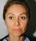 Face Lift Rejuvenation San Diego - before