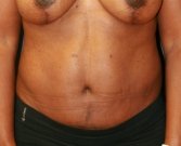 Tummy Tuck San Diego 56 - after