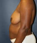 Breast Lift San Diego 23 - before