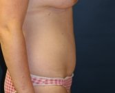 Tummy Tuck San Diego 57 - after