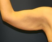 Arm Lift San Diego 9 - before