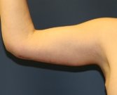 Arm Lift San Diego 9 - after