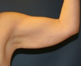 Arm Lift San Diego 10 - before