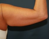 Arm Lift San Diego 11 - before