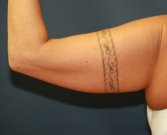 Arm Lift San Diego 12 - before