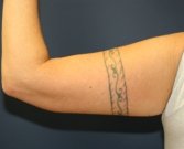 Arm Lift San Diego 12 - after