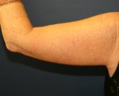 Arm Lift San Diego 14 - after