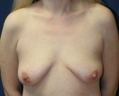 Breast-Lift-with-Implants-23 - before