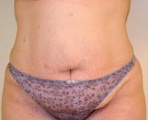 Tummy Tuck Case 18 - before