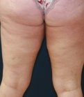 Thigh Lift San Diego - before
