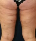 Thigh Lift San Diego - after