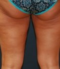 Thigh Lift/Thigh Gap - before