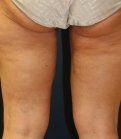 Thigh Lift/Thigh Gap - after