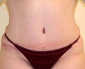 Tummy Tuck Case 18 - after