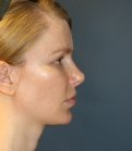 Rhinoplasty San Diego 111 - after