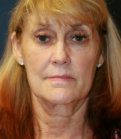 Face and Neck Lift without Browlift - before