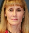 Face and Neck Lift without Browlift - after
