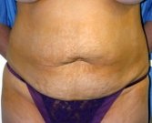 Tummy Tuck Case 13 - before