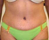 Tummy Tuck Case 13 - after