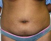Tummy Tuck Case 19 - before