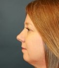 Rhinoplasty-san-diego-46 - after