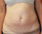 Tummy Tuck (Short Scar) San Diego 61 - before