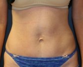 Tummy Tuck (Short Scar) San Diego 61 - after