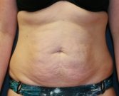 Tummy Tuck San Diego 60 - before