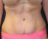 Tummy Tuck San Diego 60 - after