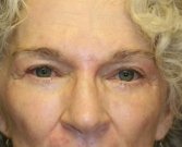 Eyelid Refresh San Diego 76 - after