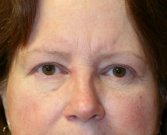 Eyelid Refresh San Diego 77 - after