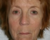 Eyelid Refresh San Diego 78 - before